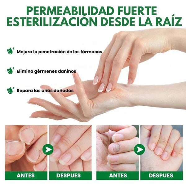 Compra 1 y llevate 2👋🦠Anti Hongos Uñas - 7 Days™  2UND 30ml