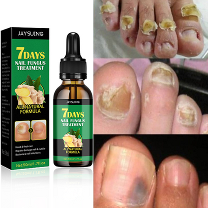 Compra 1 y llevate 2👋🦠Anti Hongos Uñas - 7 Days™  2UND 30ml