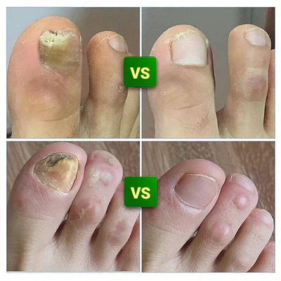 Compra 1 y llevate 2👋🦠Anti Hongos Uñas - 7 Days™  2UND 30ml