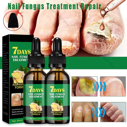 Compra 1 y llevate 2👋🦠Anti Hongos Uñas - 7 Days™  2UND 30ml