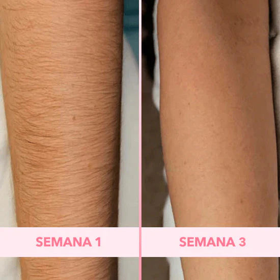 ⚡💡50% OFF ⚡💡 Depiladora Láser IPL Suavidad Láser en Casa